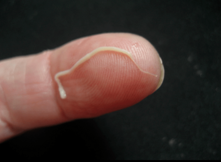 Roundworm Parasite gikan sa lawas sa tawo